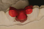 Figure  10  Jig used to aid the placement of the abutment in the patient’s mouth