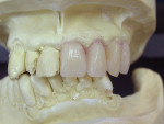 Figure  4   Denture teeth were contoured and set into each prepared socket, according to the clinician’s instructions and desired outcome.