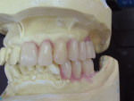 Figure  5  Since the mandibular left posteriors were missing and a prosthesis was not made yet, denture teeth were set to create an ideal plane of occlusion.