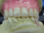 Figure  10  Denture teeth were placed and gingival wax was contoured to create an esthetic smile.