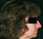 Figure 12  Pretreatment profile of a Class I patient indicates an obvious need for lip support, which is characteristic for this Class.