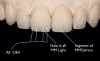 Fig 5. Development of dental side effects of MAD therapy. Photograph of female patient with teeth maximally intercuspated prior to treatment (AHI = 7.1 events/hr).