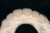 Fig 6. Photograph of teeth maximally intercuspated 1 year after patient began treatment with a MAD (Herbst appliance). With the jaw advanced 80% of maximum protrusion, the AHI was reduced to 1.4 events/hr. Compared to the pre-treatment occlusion (Figure 5), overbite and overjet had each decreased 2 mm.