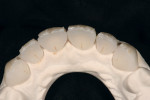 Figure  12   An incisal view of internal effects before powder enamel placement. Notice the interproximal troughs were ready for low value, highly opal (OE1) powder.