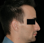 Figure 18  Profile of the patient after being made edentulous. Lip support was acceptable to the patient and clinician.