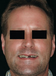 Figure 20  Pretreatment smile of a Class III patient.