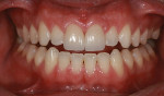 Figure 19  Retracted postoperative view of the lithium disilicate crown restorations on teeth Nos. 8 and 9.