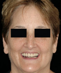 Figure 27  Posttreatment smile of the same patient illustrating the PTJ being concealed underneath the lip.