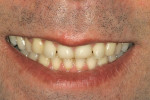 Figure 2  Preoperative smile view shows the asymmetricalupper lip, wear, and malposed anterior teeth.