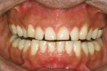 Figure 3  Retracted preoperative view shows asymmetricalgingival heights along with worn dentition.