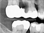 Figure 1  Initial radiograph of the large radiolucency at the site of the maxillary first molar.
