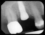 Figure 2  Radiograph of the site after implant placement and low-profile healing abutment.