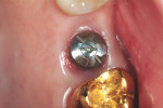 Figure 3  The Encode Healing Abutment in place after hand tightening.