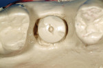 Figure 5  The definitive Encode Abutment is designed virtually after scanning of the model containing the Encode Healing Abutment.