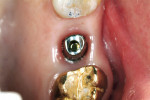 Figure 9  Occlusal view of the definitive Encode Abutment after placement in the mouth.