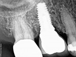 Figure 11  Six-month periapical radiograph revealing good bone height around the platform-switched implant.