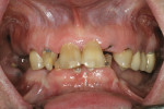 Figure 10  Patient with failed dentition.