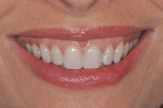 Figure 3d  Right lateral smile