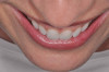 Fig 1. Preoperative extraoral view of a patient’s smile exhibiting compromised esthetic situation.
