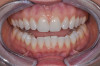 Fig 4. Diagnostic wax-up to determine functional and esthetic parameters.