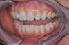 Fig 6. Full-contour CAD/CAM design of maxillary anterior teeth.