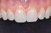 Fig 7. Full-contour monolithic high-translucent zirconia crowns for restorations for maxillary anterior teeth on the master cast.