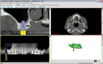 Figure 3  Simplant CT scan.