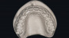 Fig 15. Selective enamel etching of abutment teeth with phosphoric acid for 20 seconds.