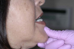 Figure 3  To evaluate tenderness of the lateral pterygoid muscle, the patient protrudes the mandible against the resistance of the practitioner’s thumb on the chin.