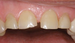 Figure 6  Incisal wear and attrition. Mandibular anterior teeth: (A) incisal view and (B) facial view. Maxillary anterior teeth: (C) incisal view and (D) facial view.