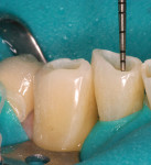 Figure 7  Intradentin preparation of mandibular anterior incisal edges to a depth of 1 mm, leaving the enamel intact for bonding and restoration.