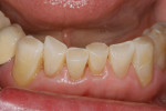 Figure 11a  Completed restorations of incisal edges: <strong>(A)</strong> mandibular restorations,(B) maxillary restorations.