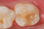 Figure 6  An occlusal view of the bulk fill layer after light curing.