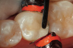 Figure 11  This occlusal view shows the sculpting of the occlusal surface of the Class II composite restoration.