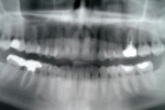 Figure 1  Panorex showing intact dentition, periapical lesion over tooth No. 3, and widened PDL over maxillary posterior teeth.
