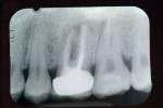 Figure 2  Periapical x-ray of tooth No. 3, with radiolucency extending into the furcation area. Teeth Nos. 2 and 4 have widened PDLs associated with occlusal trauma from nocturnal grinding.