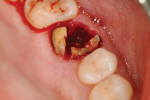 Figure 4  Distal–buccal root removed; mesial–buccal and palatal roots remain.