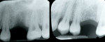 Figure 5  Radiograph day 56 (2 months) and day 112 (4 months). The osseous crest has healed naturally.