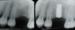 Figure 6  Radiograph pre- and post-implant placement.