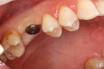 Figure 9: Healing abutment in place.