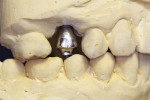 Figure 10  One piece casting for screw-retained implant restoration.