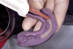 Figure 1  Bisacryl provisional material is placed in a matrix fashioned from the diagnostic wax-up prior to placement in the mouth.