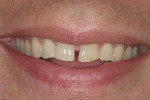 Figure 9: This view demonstrates the patient’ss natural smile prior to restoration of teeth Nos. 7 through 10.