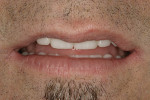 Figure 13  The patient exhibits changes in repose with provisional restorations.