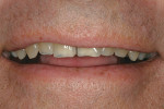 Figure 14  Pretreatment image of the patient’ss natural smile exhibits teeth in the A4 shade range.