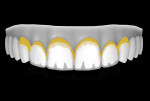 Figure 21  A second application of grey tint helps lower the value of the interproximal area to mimic the lower value of the natural teeth in this area.