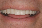 Figure 24  The natural smile of the patient during the provisional phase of dental treatment allows the patient to visualize a radical change in shade and value.
