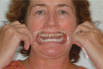 Figure 9: A full-smile photograph is achieved by having the patient say 