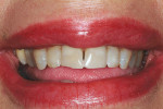 Figure 7  Images of a full-face smile and a close-up smile are crucial for planning and laboratory communication.