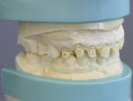 Figure 8  View of a scored model. Note the gingival areas and the retentive areas.